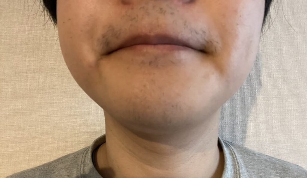 10回目の脱毛から1か月後