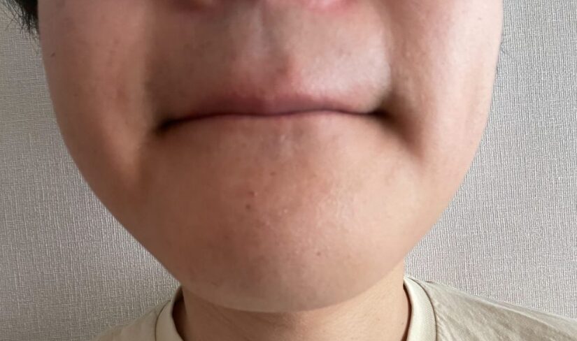 12回目のヤグレーザーから1か月後